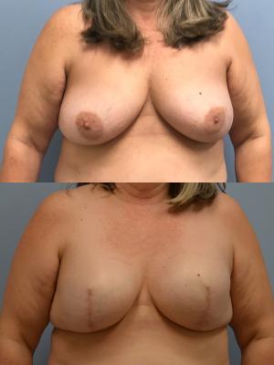 Before(top pic) After (bottom pic): Breast Reconstruction