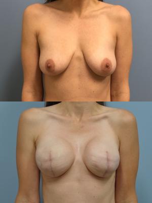 Before(top pic) After (bottom pic): Breast Reconstruction