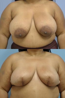 Before(top pic) After (bottom pic): Breast Reconstruction