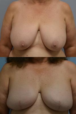 Before(top pic) After (bottom pic): Breast Reconstruction