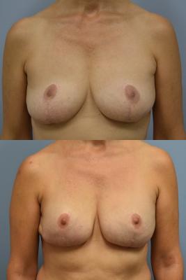 Before(top pic) After (bottom pic): Breast Reconstruction