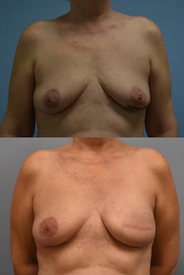 Left breast expander exchange for implant, Left revision of reconstructed breast, Right mastopexy for symmetry