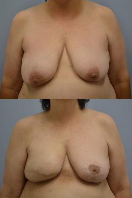 Before(top pic) After (bottom pic): Breast Reconstruction