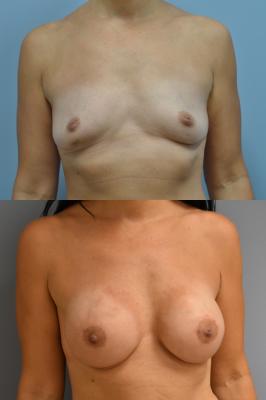 Before(top pic) After (bottom pic): Breast Reconstruction