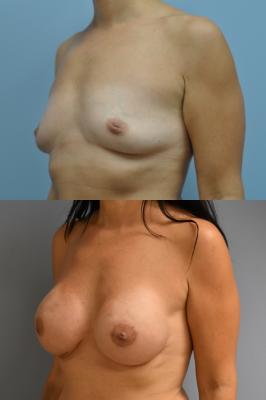 Before(top pic) After (bottom pic): Breast Reconstruction