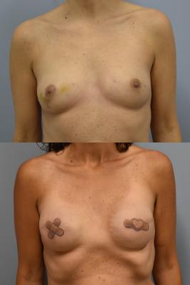 Before(top pic) After (bottom pic): Breast Reconstruction