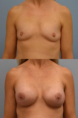 Before(top pic) After (bottom pic): Breast Reconstruction