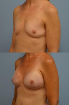 Before(top pic) After (bottom pic): Breast Reconstruction