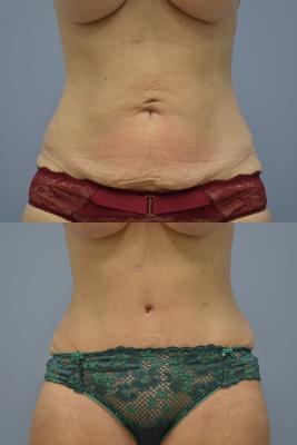 Before(top pic) After (bottom pic): Abdominoplasty