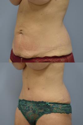 Before(top pic) After (bottom pic): Abdominoplasty