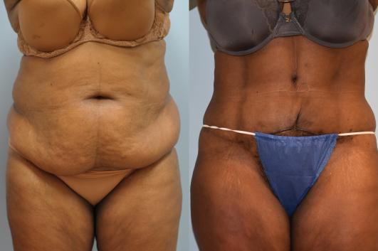 Abdominoplasty and 360 liposuction