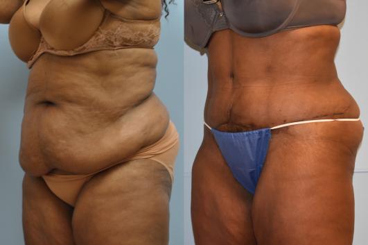 Abdominoplasty and 360 liposuction