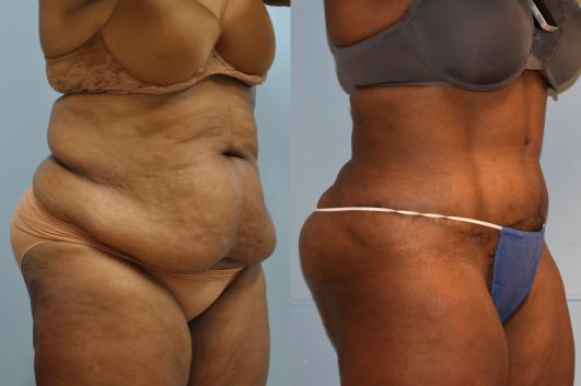 Abdominoplasty and 360 liposuction