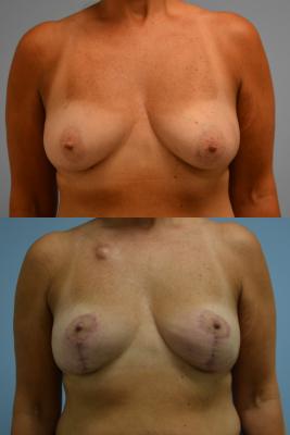 Before(top pic) After (bottom pic): Oncoplastic Breast Reduction