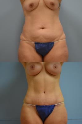 Before(top pic) After (bottom pic): Abdominoplasty, Liposuction, Breast Lift