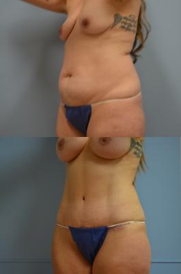 Before(top pic) After (bottom pic): Abdominoplasty, liposuction, breast lift