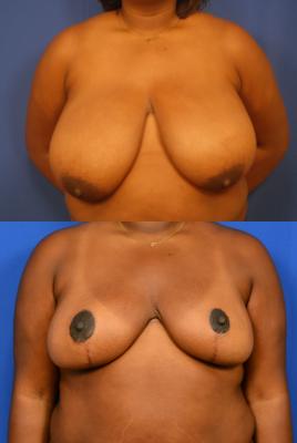 Breast_Reduc_1.jpg