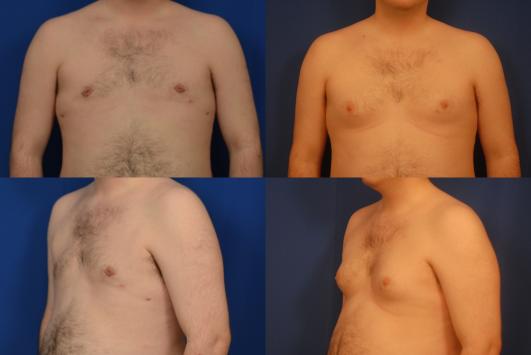 Gynecomastia_1.jpg