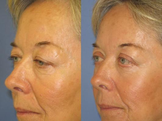 Upper And Lower Eyelid Surgery B257-264 | Summit Health