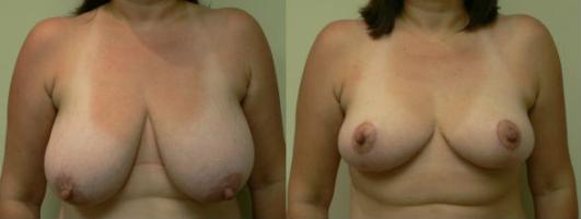 Pyo_Breast_Reduction25932-82375FINAL.jpg