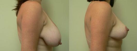 Pyo_Breast_Reduction25932-82376FINAL.jpg