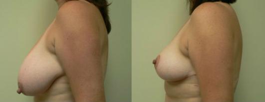 Pyo_Breast_Reduction25932-82377FINAL.jpg