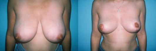 Pyo_Breast_Reduction6642-62020FINAL.jpg