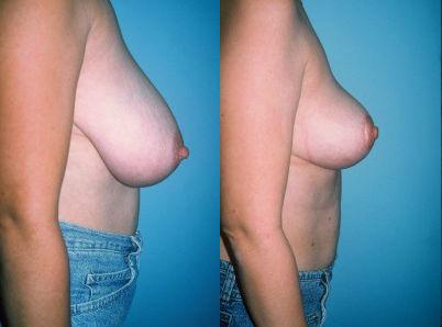 Pyo_Breast_Reduction6642-65783FINAL.jpg