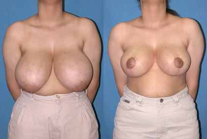 Pyo_Breast_Reduction6742-62142FINAL.jpg