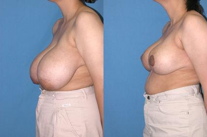 Pyo_Breast_Reduction6742-65906FINAL.jpg