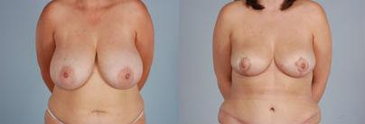 Pyo_Breast_Reduction7293-62886FINAL.jpg