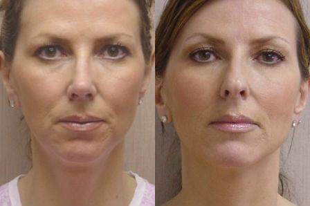 Pyo_Rhinoplasty7191-62762FINAL.jpg