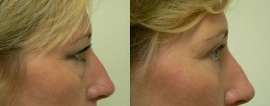 Pyo_Rhinoplasty7736-67147FINAL.jpg