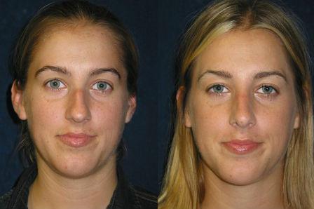 Pyo_Rhinoplasty8239-63791FINAL.jpg