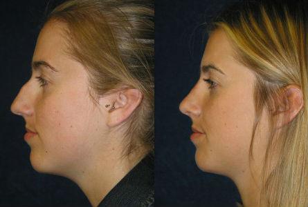 Pyo_Rhinoplasty8239-67549FINAL.jpg