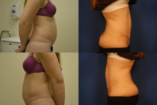 abdominoplasty-muscle-tightening-g5.jpg