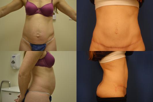 abdominoplasty-muscle-tightening-g5_JOXfMyZ.jpg