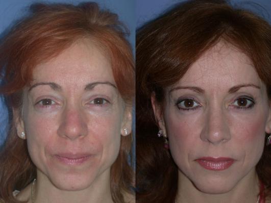 blepharoplasty-and-rhinoplasty-p1.jpg