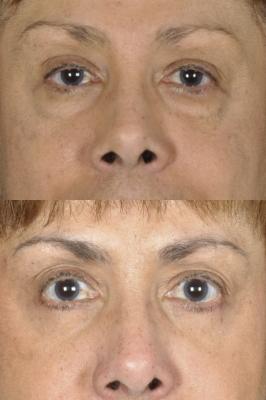 blepharoplasty-p1.jpg