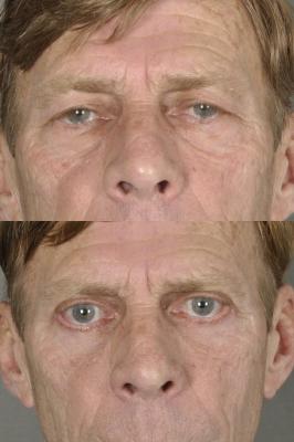 blepharoplasty-p2.jpg