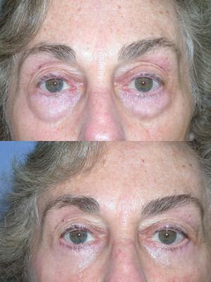 blepharoplasty-p3.jpg