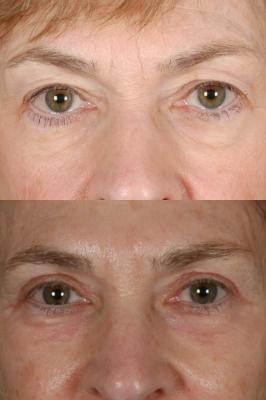 blepharoplasty-p4.jpg