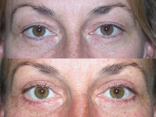 blepharoplasty-p5.jpg