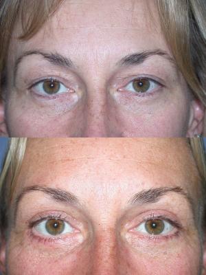 blepharoplasty-p5_mMMPpS9.jpg