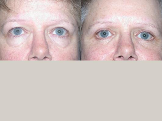 blepharoplasty-p6.jpg