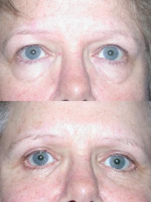 blepharoplasty-p6_zHkzDXA.jpg