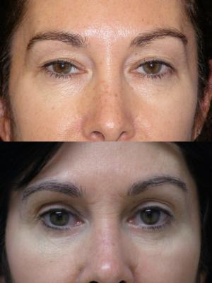 blepharoplasty-p8.jpg