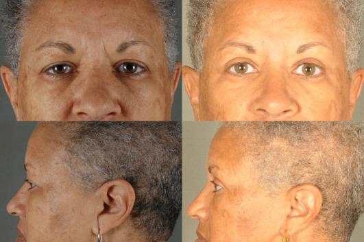 blepharoplasty-upper-eyelids-g7_pN1Q7oA.jpg