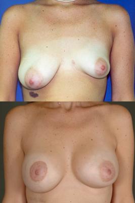 breast-asymmetry-and-augmentation-p14.jpg