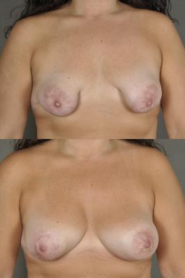 breast-asymmetry-augmentation-and-lift-p2.jpg